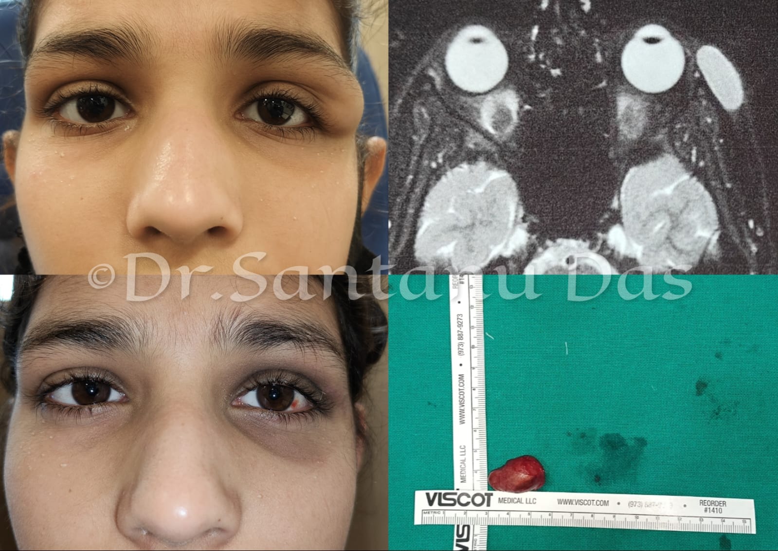 Orbital Lesion 1